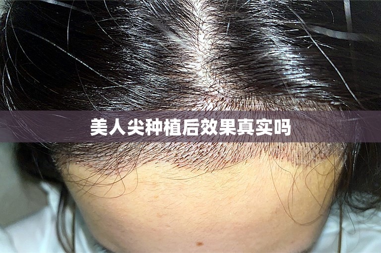 美人尖种植后效果真实吗