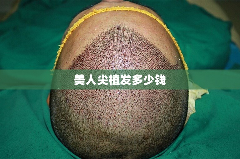 美人尖植发多少钱