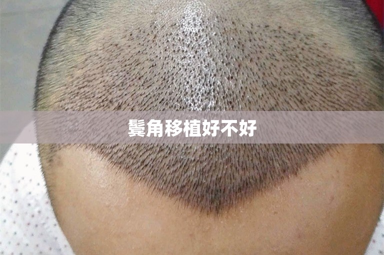 鬓角移植好不好