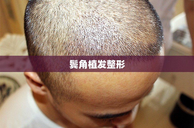 鬓角植发整形 鬓角植发整形