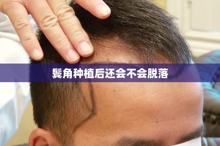 鬓角种植后还会不会脱落
