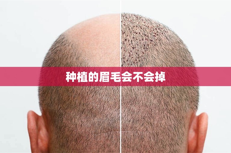 种植的眉毛会不会掉