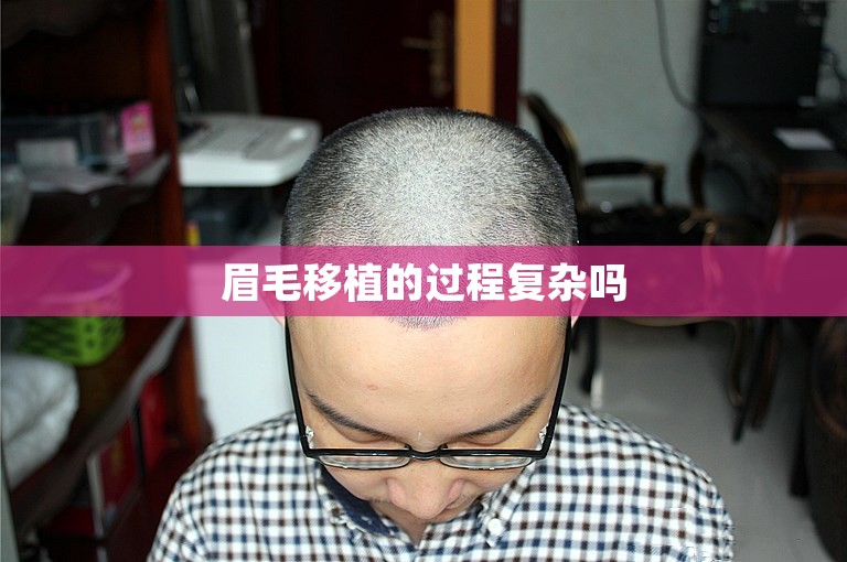 眉毛移植的过程复杂吗