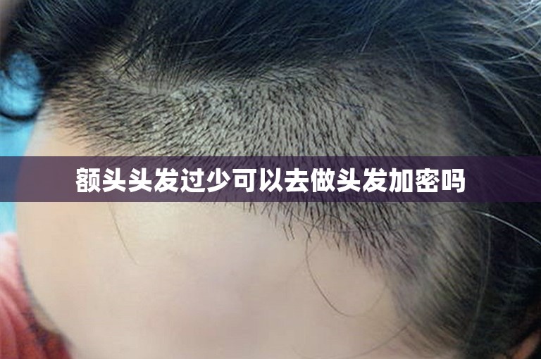 额头头发过少可以去做头发加密吗 额头头发过少可以去做头发加密吗