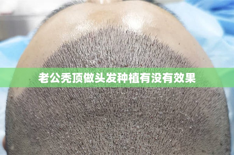 老公秃顶做头发种植有没有效果