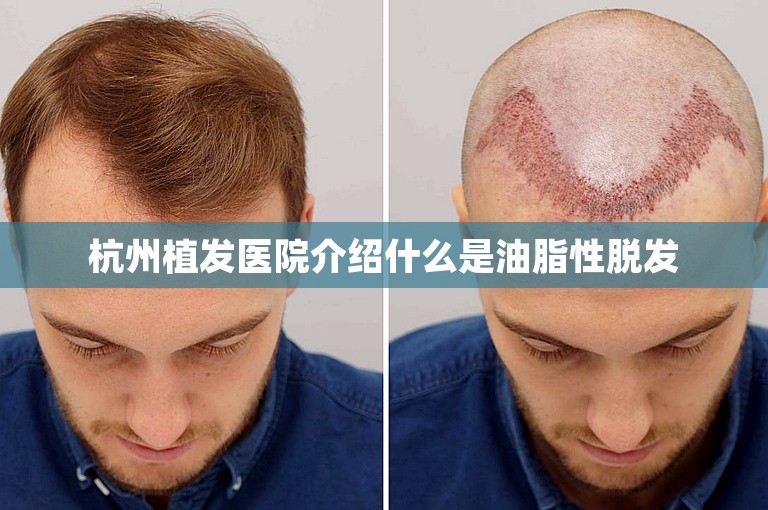 杭州植发医院介绍什么是油脂性脱发