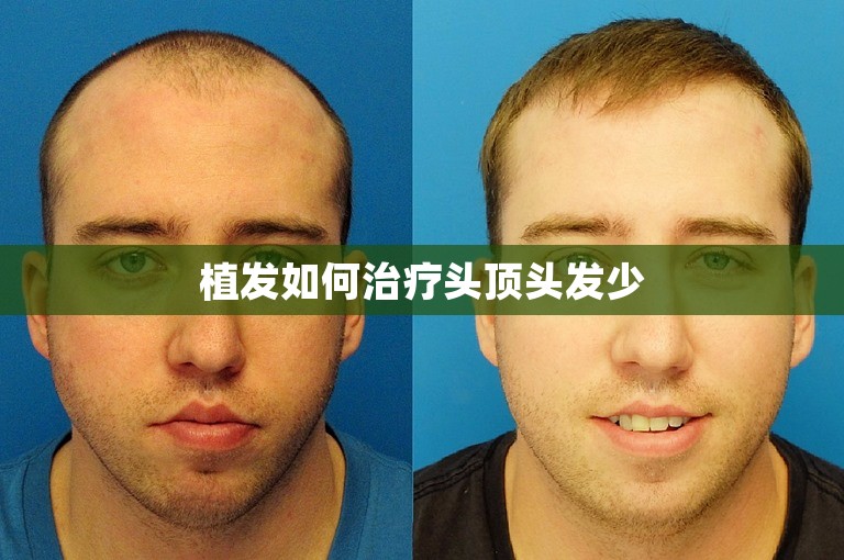植发如何治疗头顶头发少