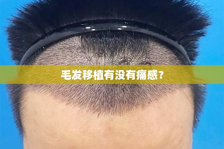 毛发移植有没有痛感？