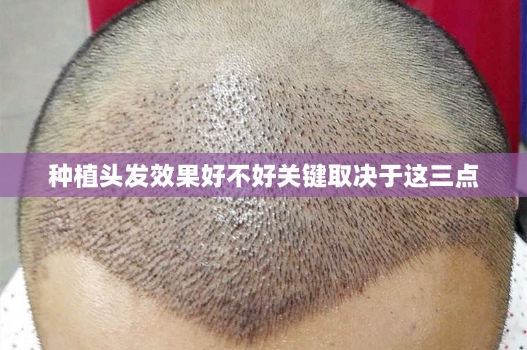 种植头发效果好不好关键取决于这三点