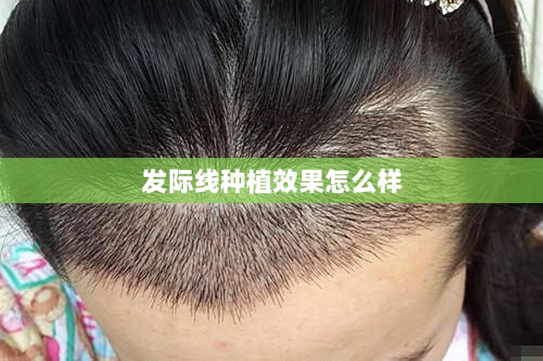发际线种植效果怎么样