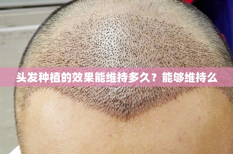 头发种植的效果能维持多久？能够维持么