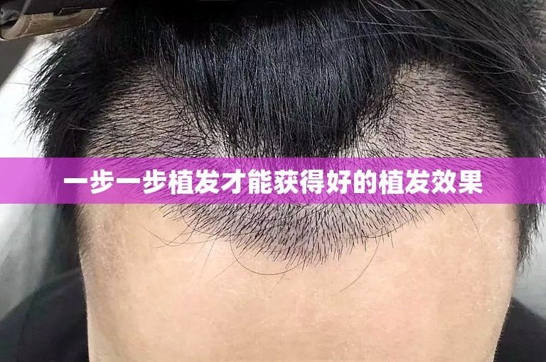 一步一步植发才能获得好的植发效果