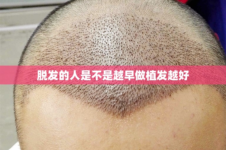 脱发的人是不是越早做植发越好
