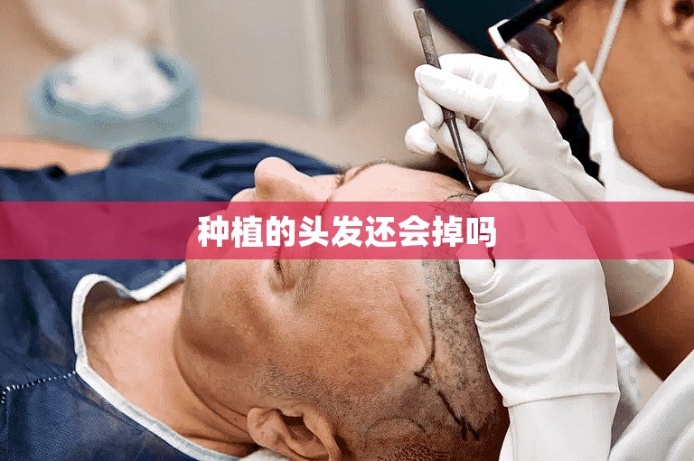 种植的头发还会掉吗