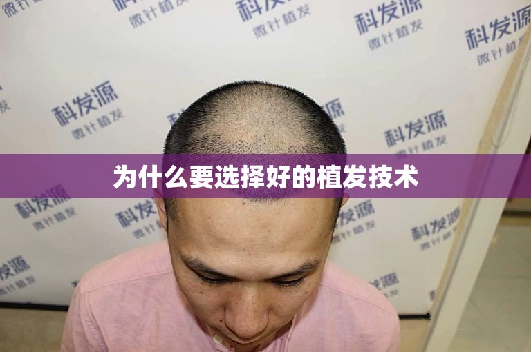 为什么要选择好的植发技术