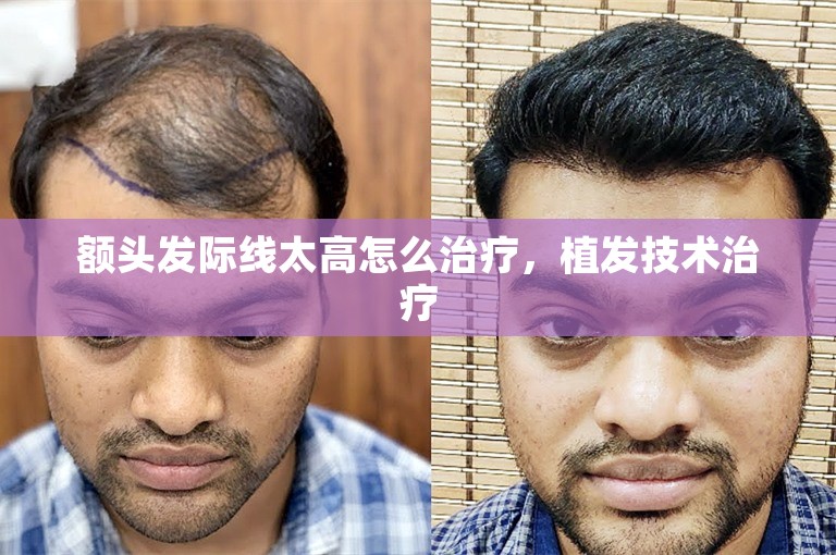 额头发际线太高怎么治疗，植发技术治疗