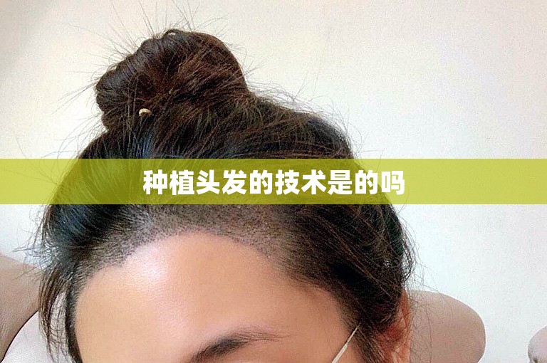种植头发的技术是的吗