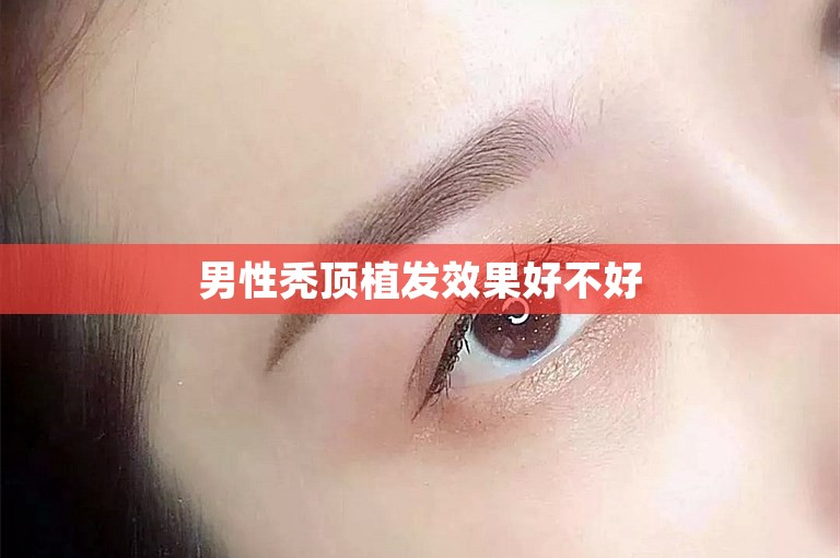 男性秃顶植发效果好不好