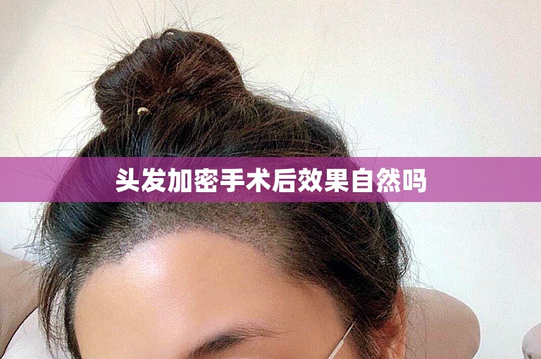 头发加密手术后效果自然吗