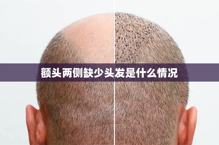 额头两侧缺少头发是什么情况 额头两侧缺少头发是什么情况