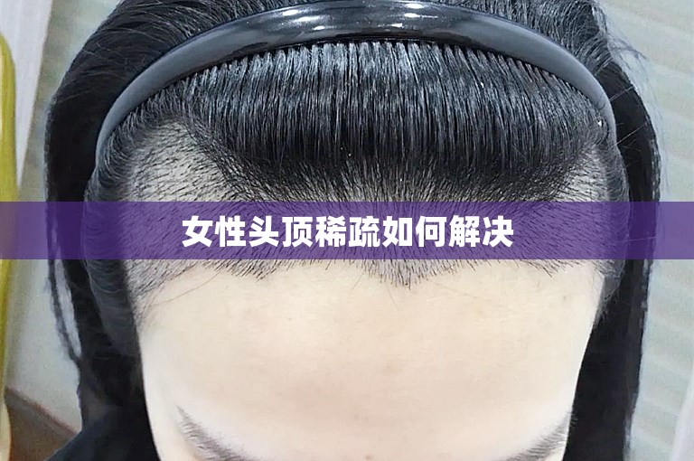 女性头顶稀疏如何解决
