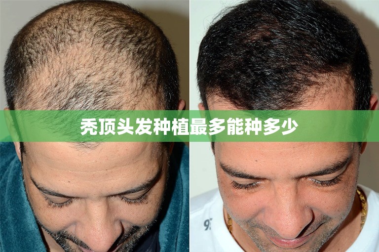 秃顶头发种植最多能种多少