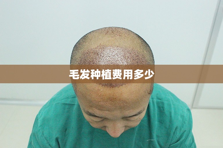 毛发种植费用多少