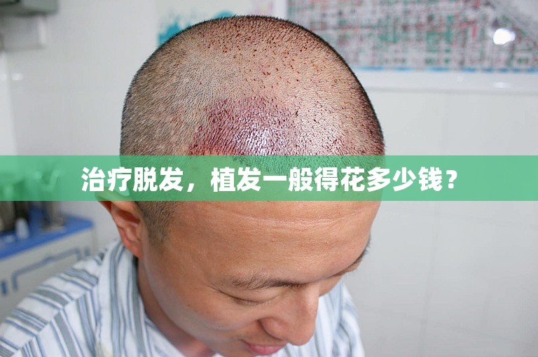 治疗脱发，植发一般得花多少钱？