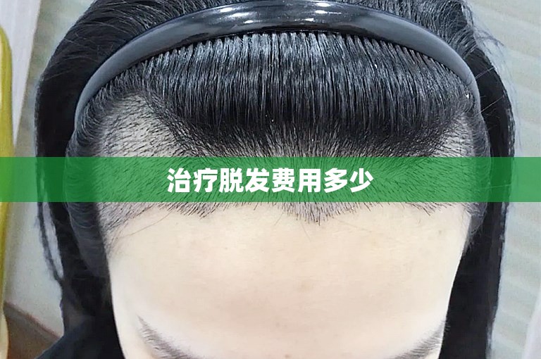 治疗脱发费用多少