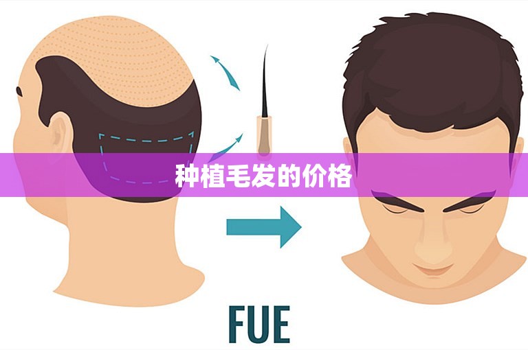 种植毛发的价格