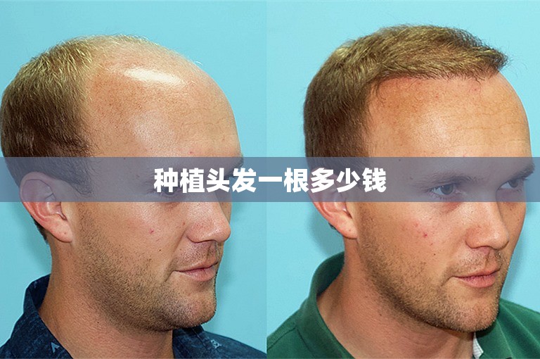 种植头发一根多少钱