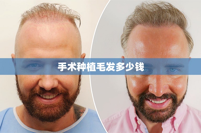 手术种植毛发多少钱 手术种植毛发多少钱