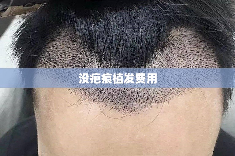 没疤痕植发费用
