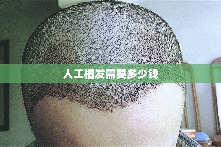 人工植发需要多少钱