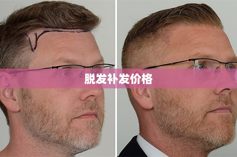 脱发补发价格