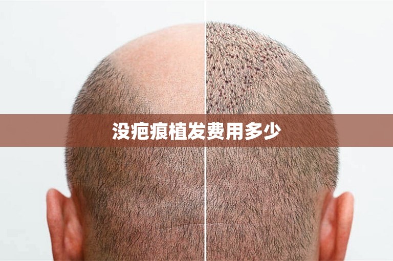 没疤痕植发费用多少
