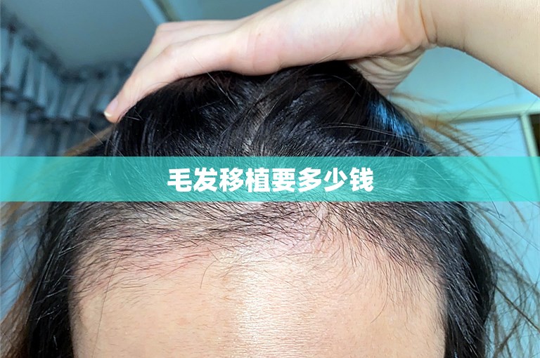 毛发移植要多少钱