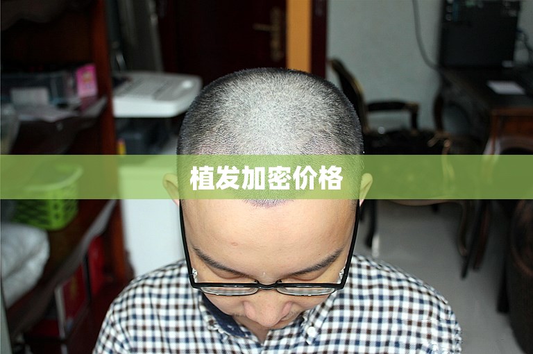 植发加密价格
