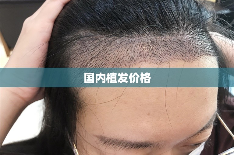 国内植发价格