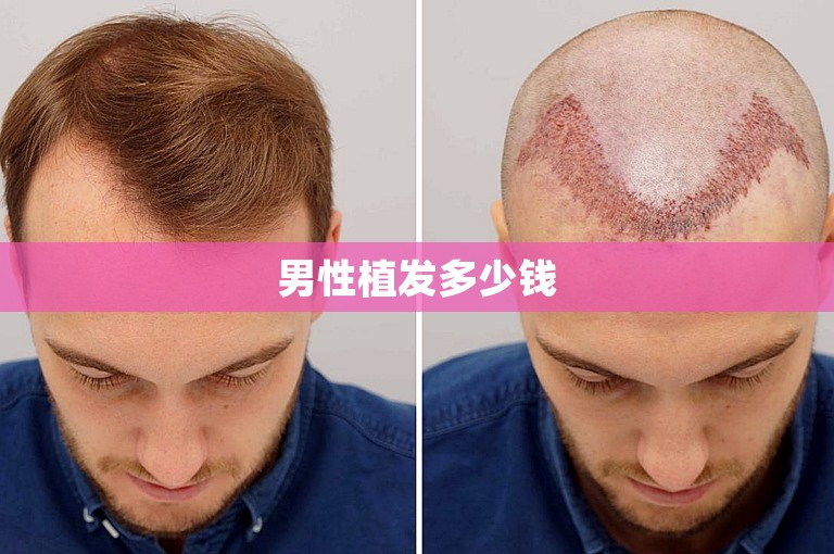 男性植发多少钱