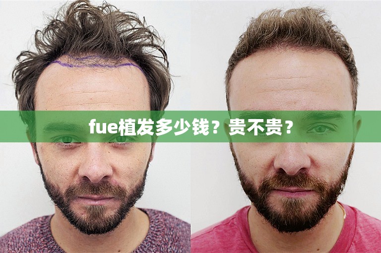 fue植发多少钱？贵不贵？