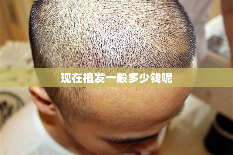 现在植发一般多少钱呢