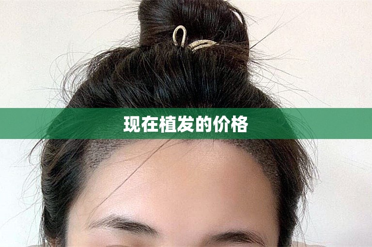 现在植发的价格