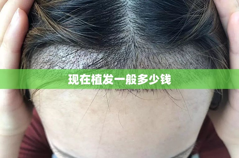 现在植发一般多少钱