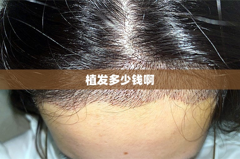 植发多少钱啊
