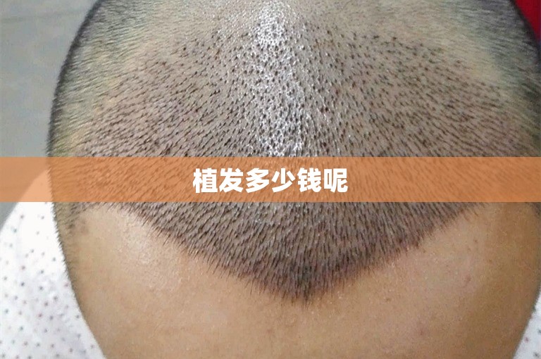 植发多少钱呢