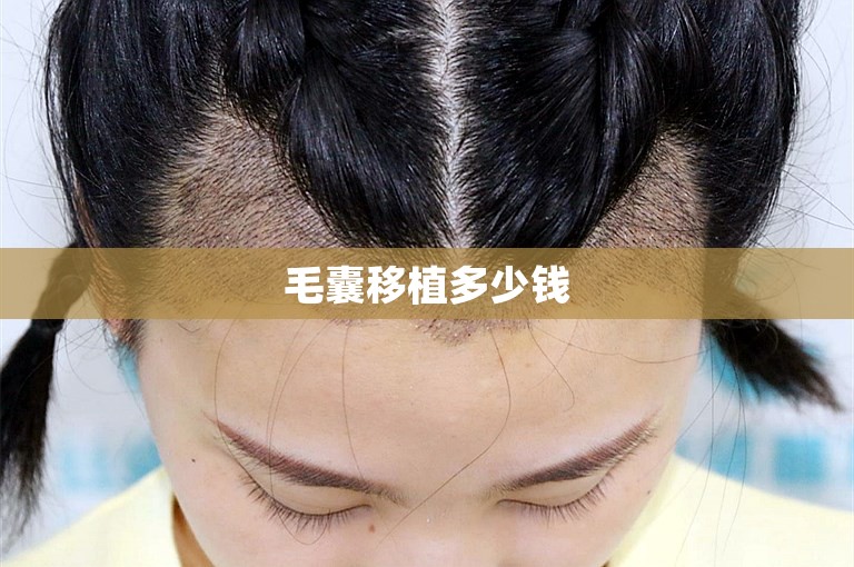毛囊移植多少钱