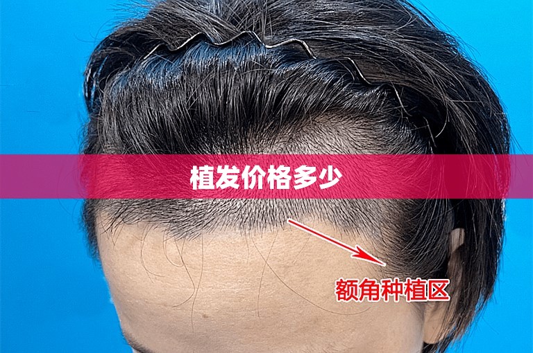 植发价格多少