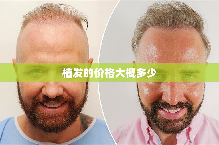 植发的价格大概多少