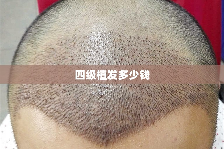四级植发多少钱